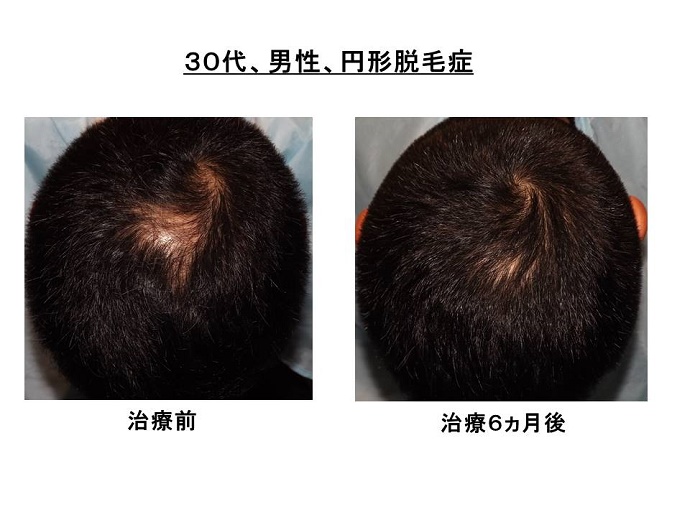 円形脱毛症　病院""